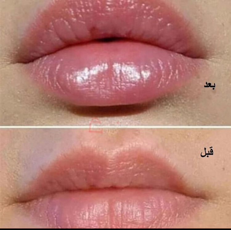 فیلر لب